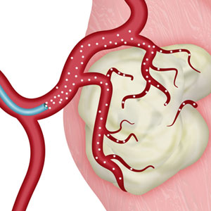 Uterine Fibroid Embolization (UFE)