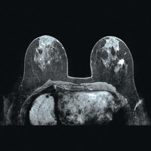 breast MRI