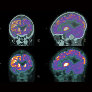 pet/ct scan