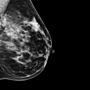 Tomosynthesis/3D Mammography