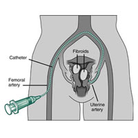 uterine fibroid embolization