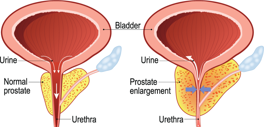 enlarged prostate - PAE in Houston - Synergy Radiology