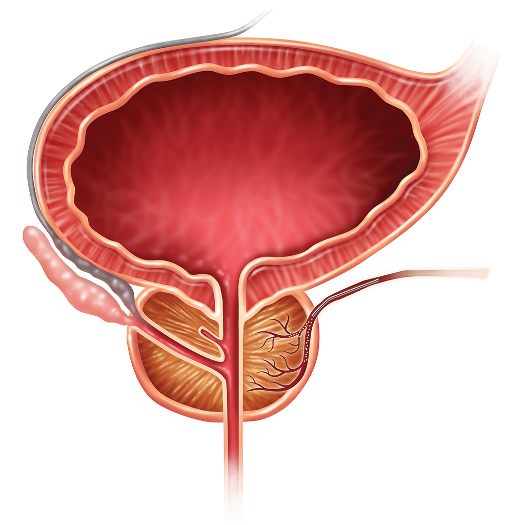 PAE - Prostate Artery Embolization at Houston Based Synergy Radiology